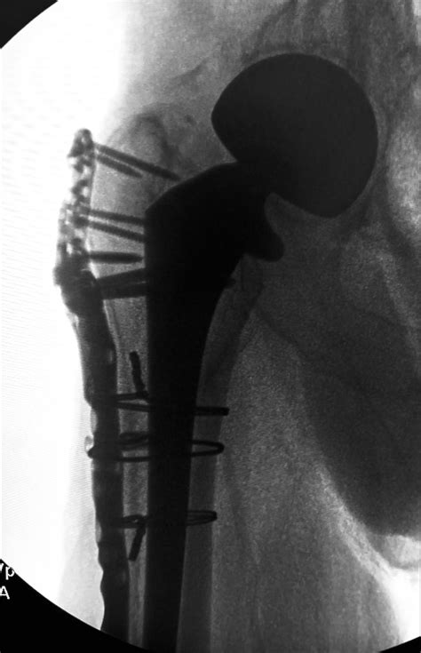 hip hemiarthroplasty orthobullets|Total Hip Arthroplasty or Hemiarthroplasty for Hip Fracture.